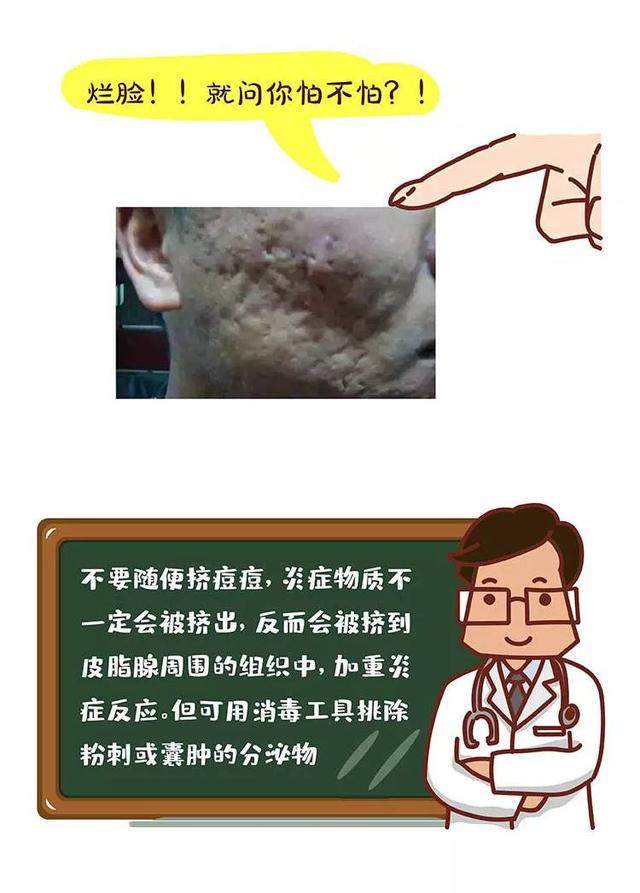 你挤痘痘的样子就像在玩命