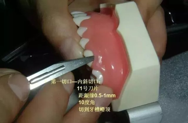 牙医干货牙医必备技能之松牙固定术
