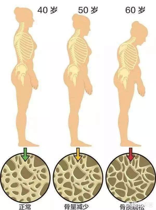 当骨量进一步丢失的时候,老年人就会开始出现,骨关节的变形也会出现变