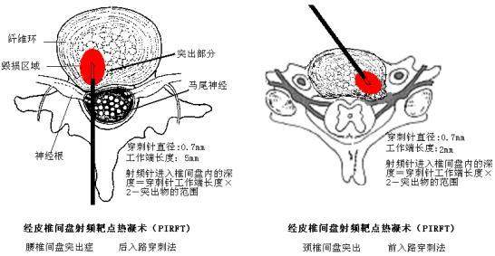 低温等离子腰椎间盘突出消融术具体操作原理为:在c形臂或ct引导下,将