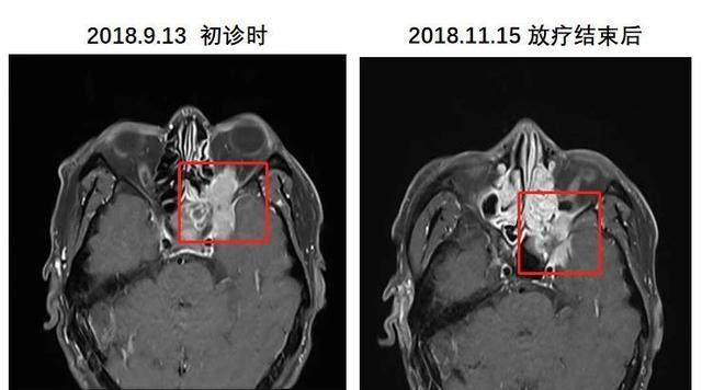 鼻咽部,左侧鼻后孔,左侧上颌窦后上方,左眶尖及左侧翼腭窝区异常软