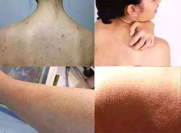 鸡皮肤能使劲搓掉吗(用澡巾使劲搓可以去鸡皮肤吗)