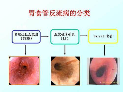 其实这种反酸和烧心的症状多数是因为反流性食管炎引起的,近20年反流