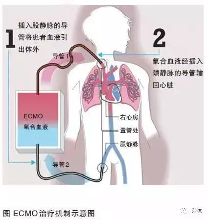 ecmo基本结构图图片