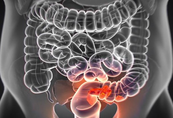 腸道開始癌變排便會有這3種異常若佔1個最好去查一下