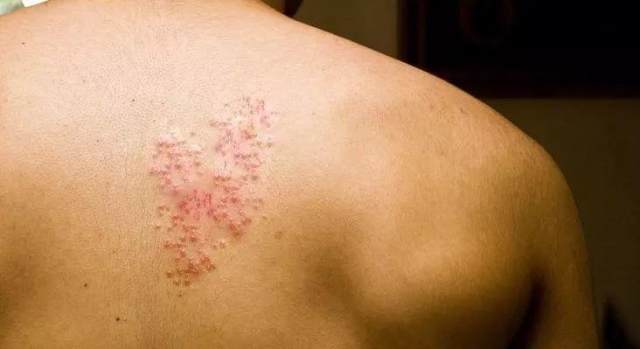 病毒邪恶的一面就会释放出来,针刺样,电击样,火烧样疼痛,伴随的是皮肤